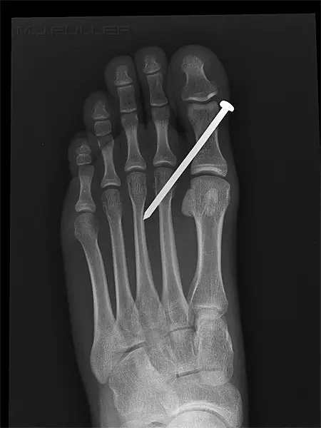 X-ray of foot with surgical pin.